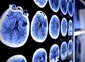 Brain Diagnosis
