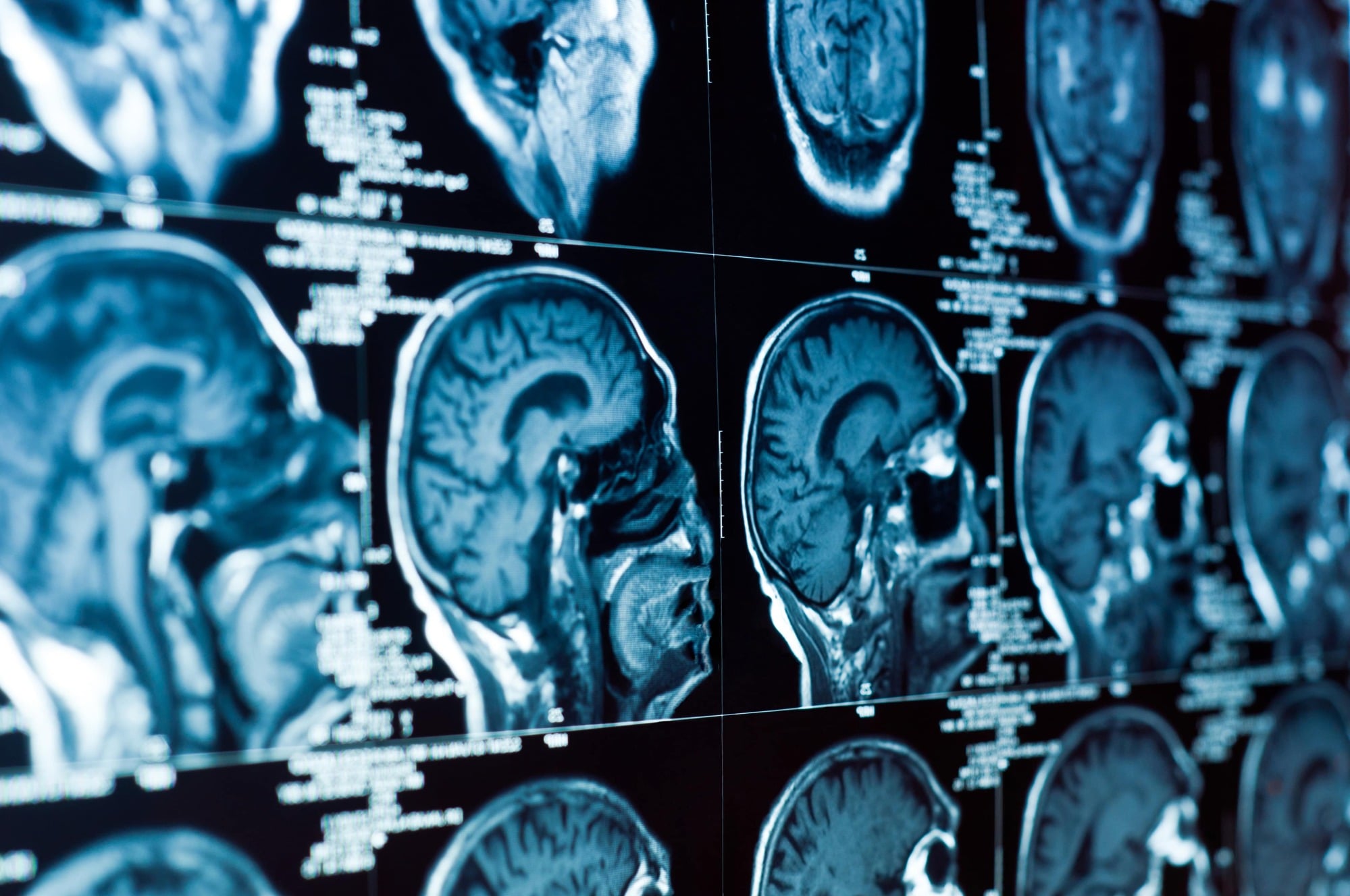 brain injury lawyer Biltmore, AZ